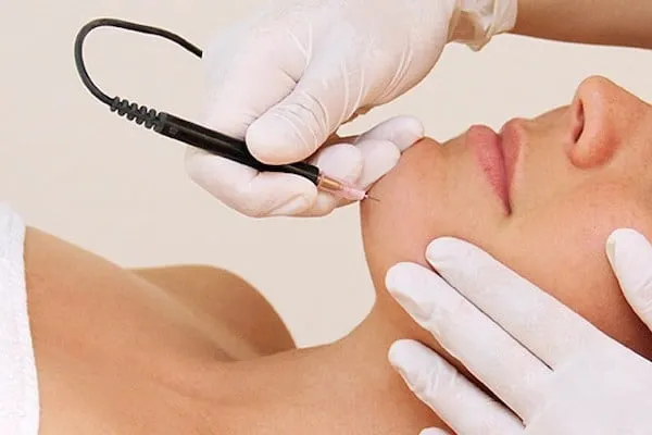 Electrolysis Treatment